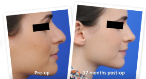 rhinoplasty plastic surgeons in melbourne Dr. Andrew Greensmith