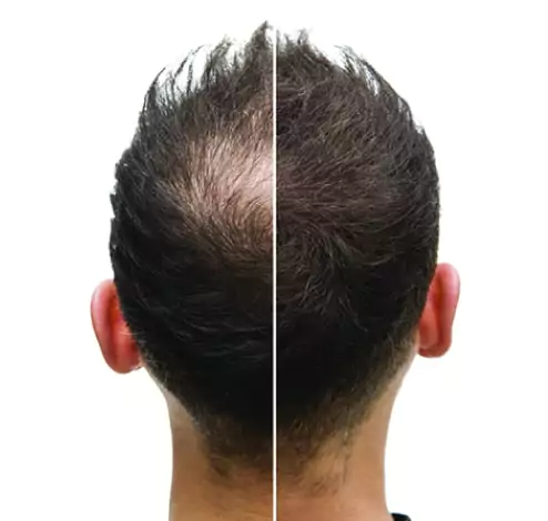hair graft clinics in melbourne Hair and Skin Science Melbourne CBD - Affordable Hair Loss & Skin Treatments